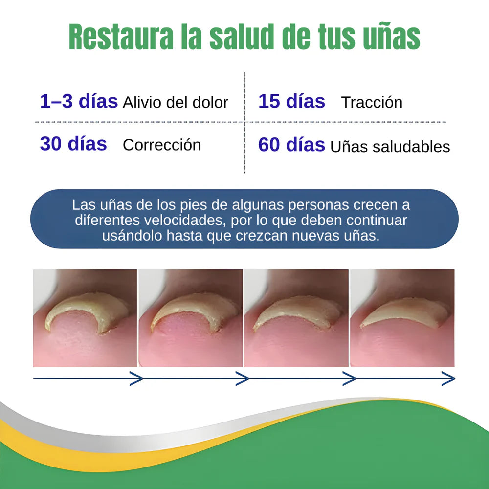 Uñas encarnadas nunca más 💅: Parche Corrector NANEL™ (50 uds) – Discreto y súper firme 🩹✨