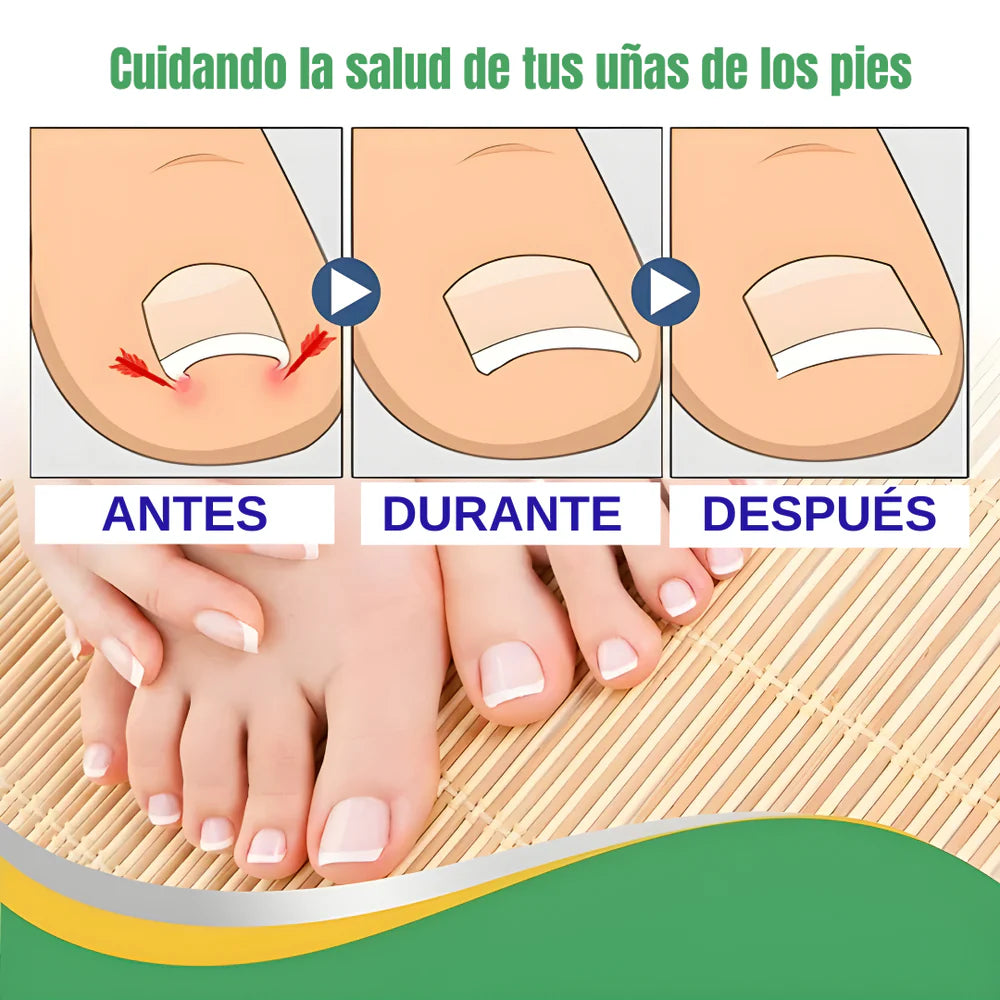 Uñas encarnadas nunca más 💅: Parche Corrector NANEL™ (50 uds) – Discreto y súper firme 🩹✨